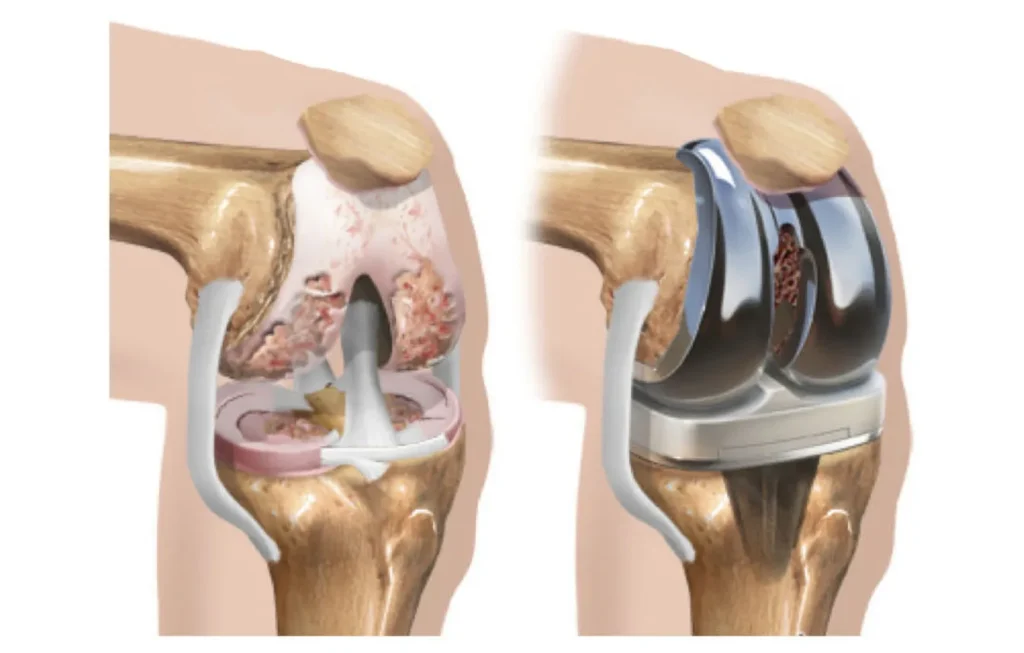 How Knee Replacement Professionals Track Progress Through Recovery How Knee Replacement Professionals Track Progress Through Recovery